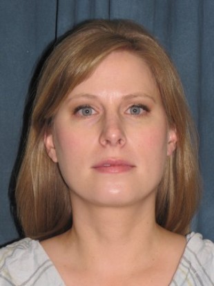 Rhinoplasty Patient 2