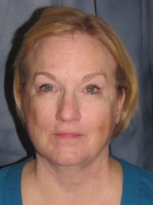 Facelift Patient 6