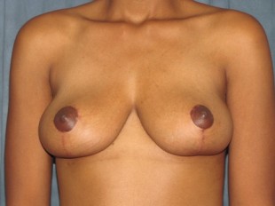 Breast Lift Patient 2