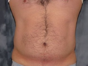 Male Patient 6 – liposuction of the torso