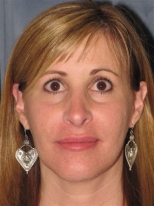 Rhinoplasty Patient 7