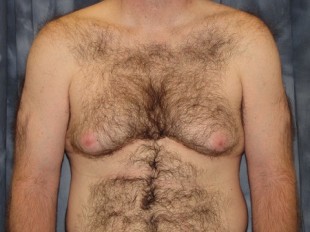 Male Patient 4 – Gynecomastia