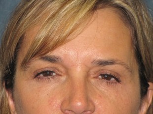Botox and Juvederm Patient 2