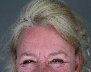 Botox Patient 6