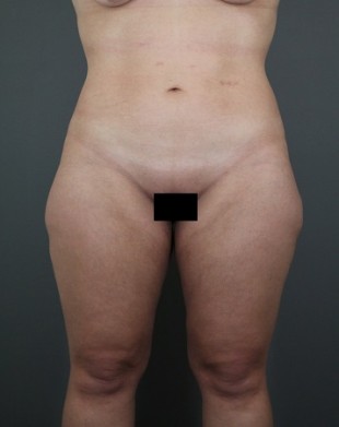 Liposuction Patient 14