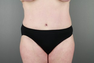 tummy tuck 35