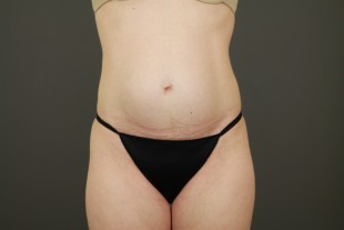 Tummy Tuck 32