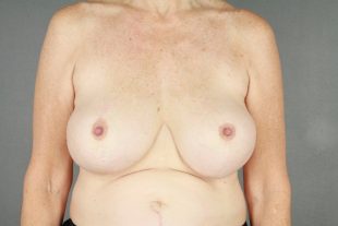 Breast Implant Removal