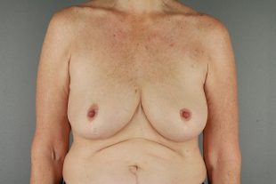 Breast Implant Removal