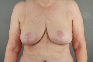 Breast Reduction 17