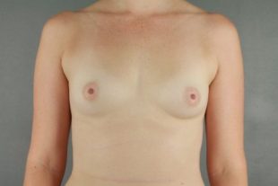 Breast Augmentation