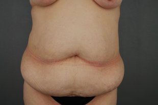 client 11- extended abdominoplaty with sal flanks