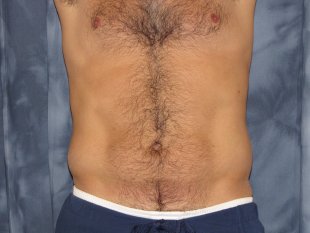 client 25 – SAL abdomen and flanks