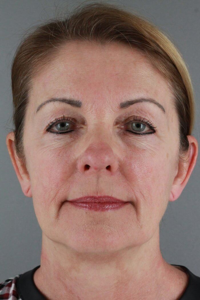 Client 67 Face lift with upper and lower eyelid lift