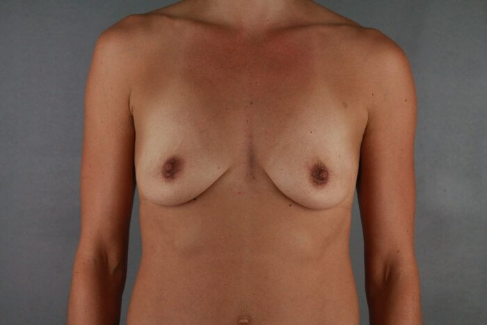 Client 69 Implants and mastopexy