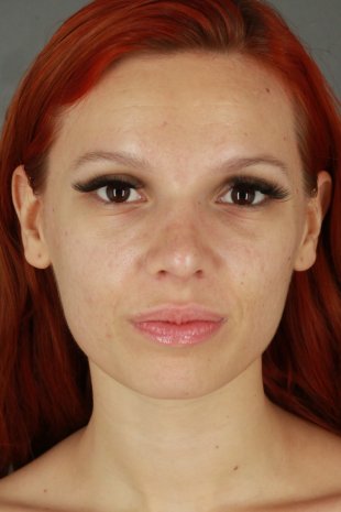 Client 95 Rhinoplasty