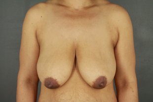 121 Mastopexy with Implants, Tummy Tuck, Liposuction Flanks.