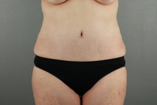 125 Scottsdale Tummy Tuck