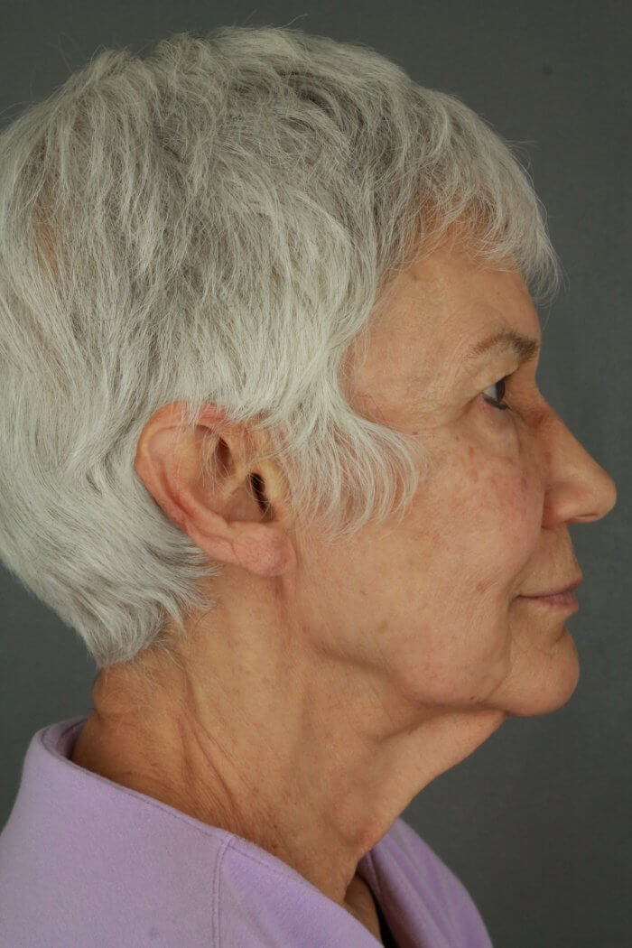 S.Bodna Before & Afters 073