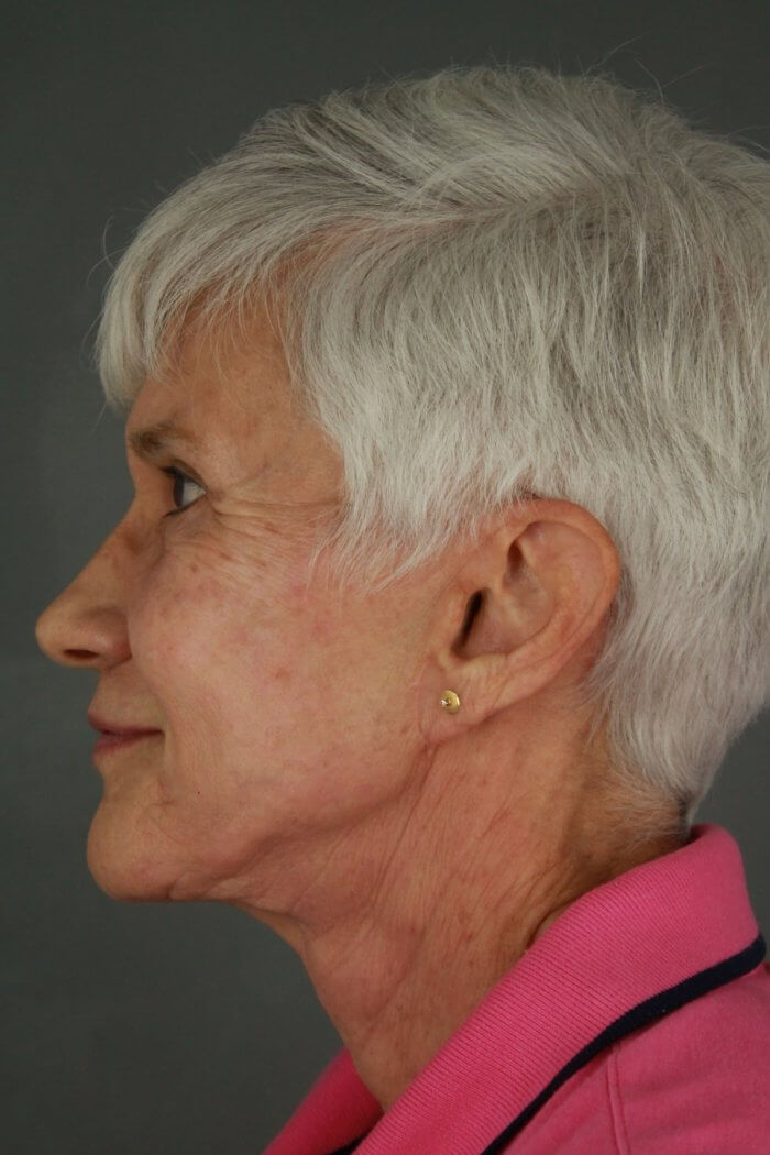 S.Bodna Before & Afters 076