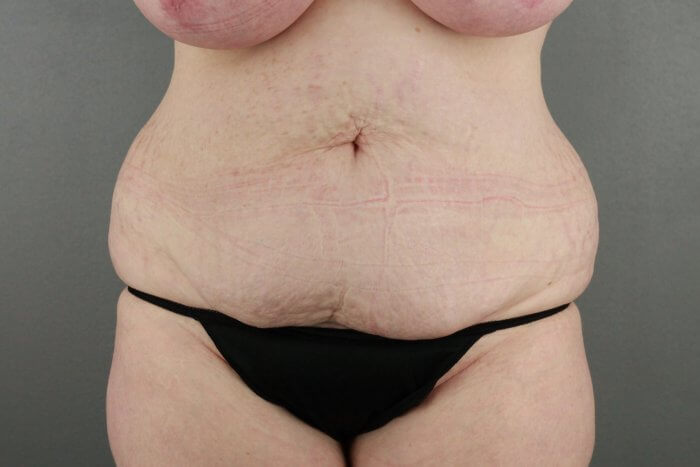 136 Tummy Tuck Scottsdale