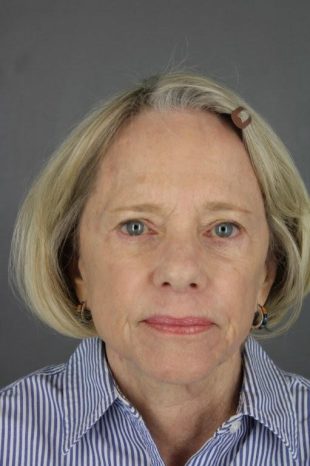 Facelift with Quad Blepharoplasty