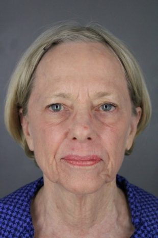 Facelift with Quad Blepharoplasty