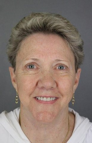 Facelift, Upper Blepharoplasty