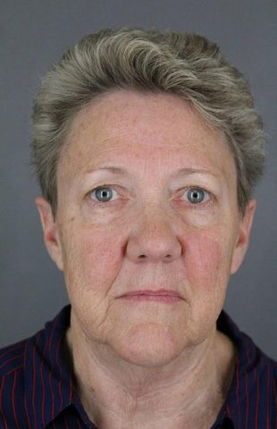 Facelift, Upper Blepharoplasty